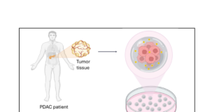 Tumore del pancreas: sensori “intelligenti” nei tessuti misurano la risposta alla chemioterapia